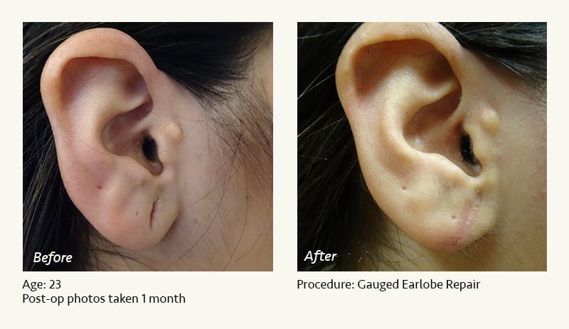 Earlobe Surgery in Plano, TX - Patient 66