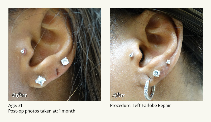 Earlobe Surgery in Plano, TX - Patient 5