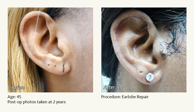Earlobe Surgery in Plano, TX - Patient 42