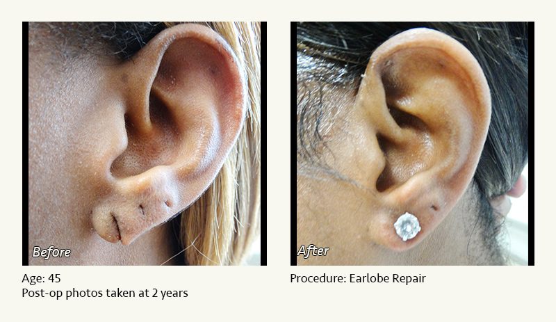 Earlobe Surgery in Plano, TX - Patient 41