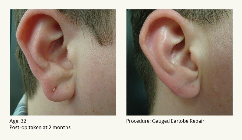 Earlobe Surgery in Plano, TX - Patient 39