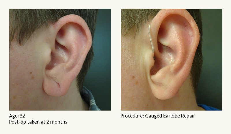 Earlobe Surgery in Plano, TX - Patient 40