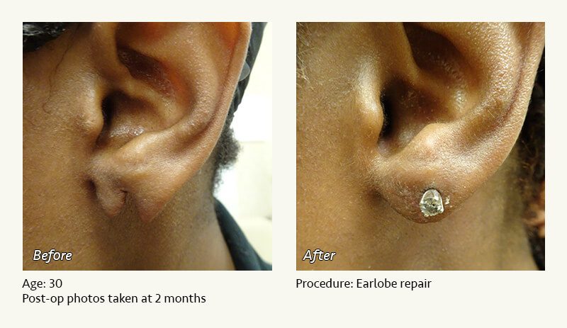 Earlobe Surgery in Plano, TX - Patient 37