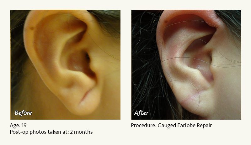 Earlobe Surgery in Plano, TX - Patient 36