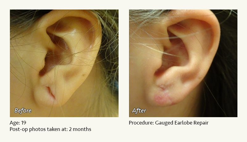 Earlobe Surgery in Plano, TX - Patient 35