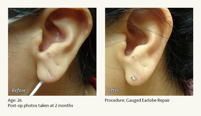 Earlobe Surgery in Plano, TX - Patient 34