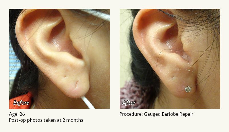 Earlobe Surgery in Plano, TX - Patient 33