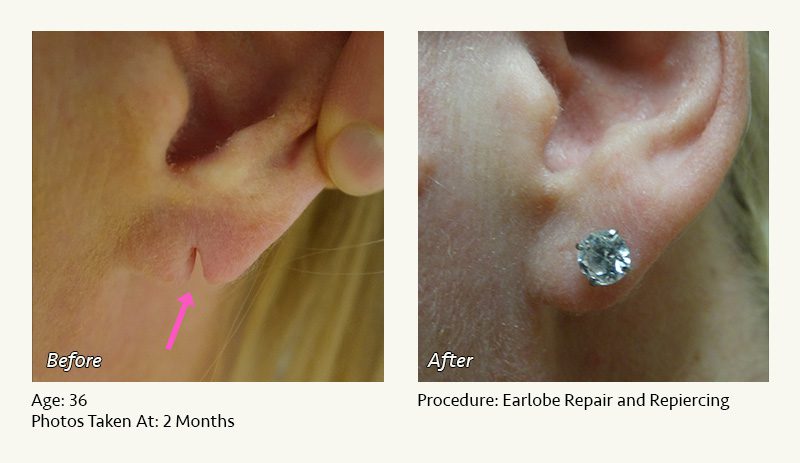 Repair Gauged Earlobes With Ear Surgery - Blogs by Ronald M. Friedman, M.D.