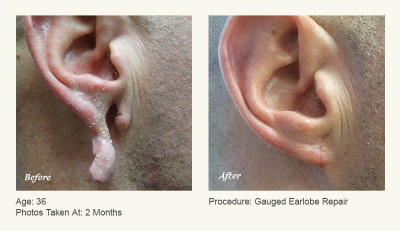 Earlobe Surgery in Plano & Dallas, TX