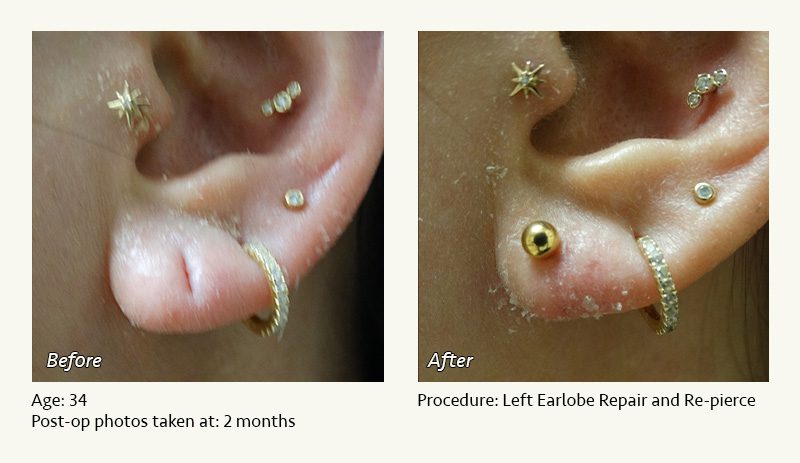 Earlobe Surgery in Plano, TX - Patient 2