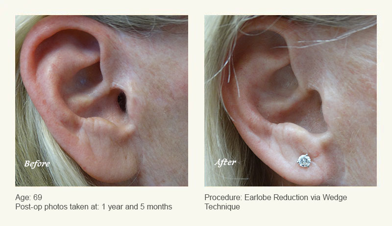 Earlobe Surgery in Plano, TX - Patient 2