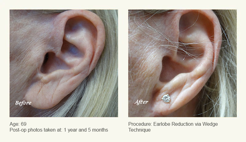 Earlobe Surgery in Plano, TX - Patient 1