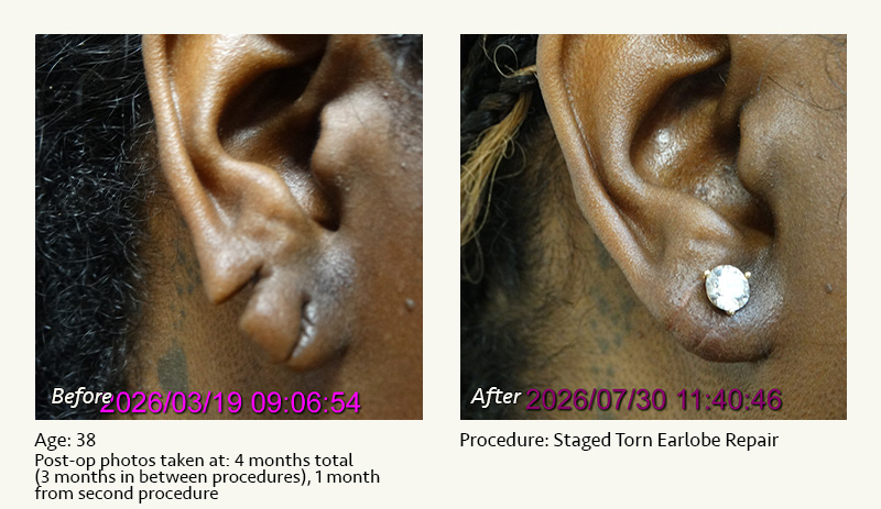 Earlobe Surgery in Plano, TX - Patient 1