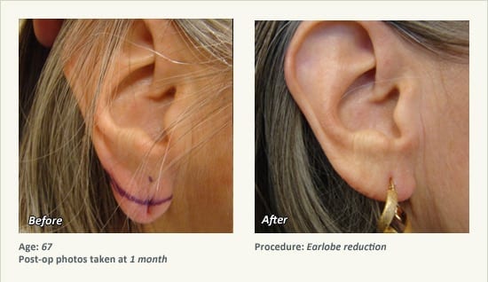 Earlobe Surgery in Plano, TX - Patient 69