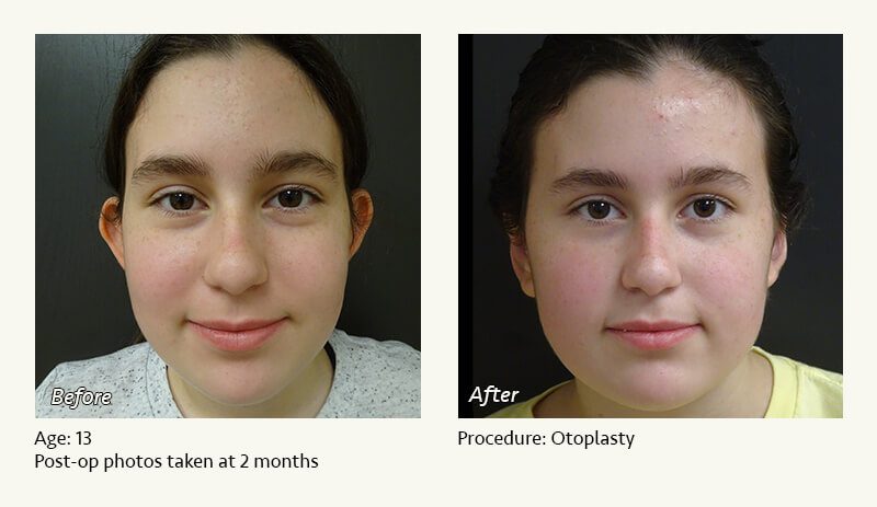 Otoplasty | Ear Pinning Surgery in Plano, TX - Patient 4