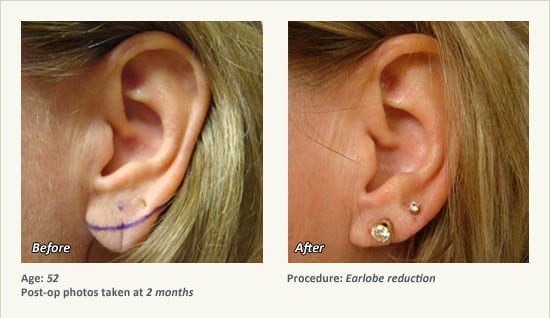 Earlobe Surgery in Plano, TX - Patient 67