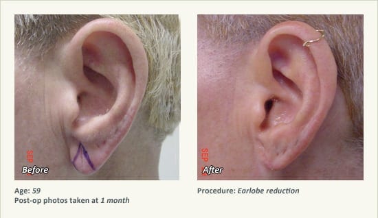 Earlobe Surgery in Plano, TX - Patient 68