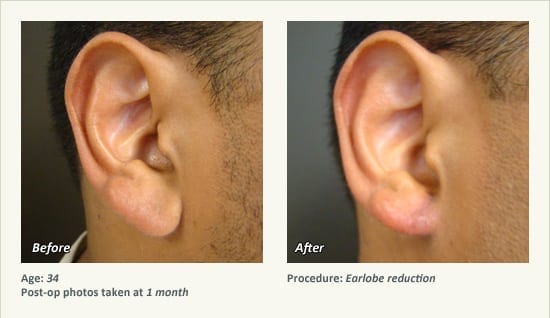 Earlobe Surgery in Plano, TX - Patient 50