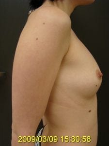 Before Breast Augmentation Side View