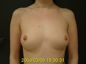 Before Breast Augmentation