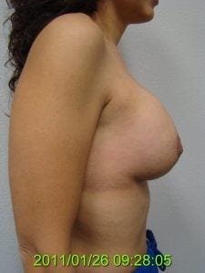 After Breast Lift Side View