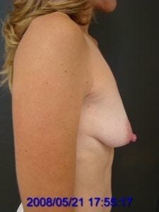 Before Breast Lift Side View