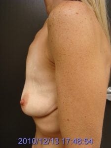 Before Breast Lift Side View