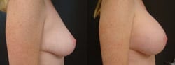 Before and After Breast Augmentation