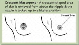 Crescent Mastopexy Incision Illustration