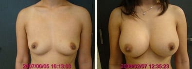 Breasts Close Together Before and After Augmentation