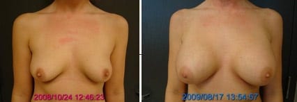 Breasts Far Apart Before and After Augmentation