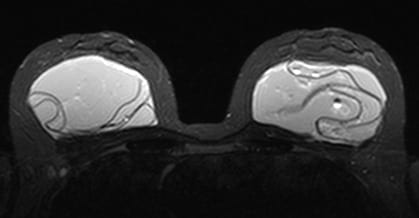 MRI of Ruptured Silicone Implants