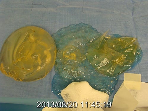 Intact and Ruptured Silicone Implants