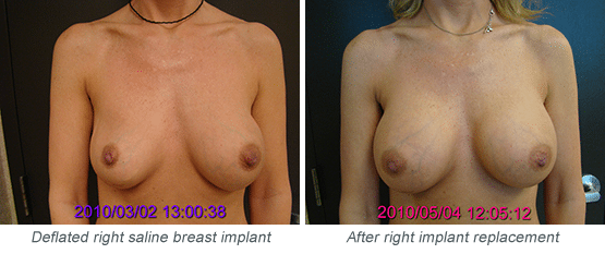 Patient with Deflated Saline Implant and After Rplacement