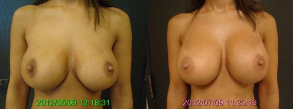 Before and After Breast Revision Front View