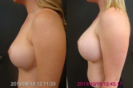 Before and After Breast Revision Side View