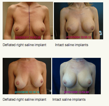 Patient with Deflated Saline Implant and After Revision Surgery