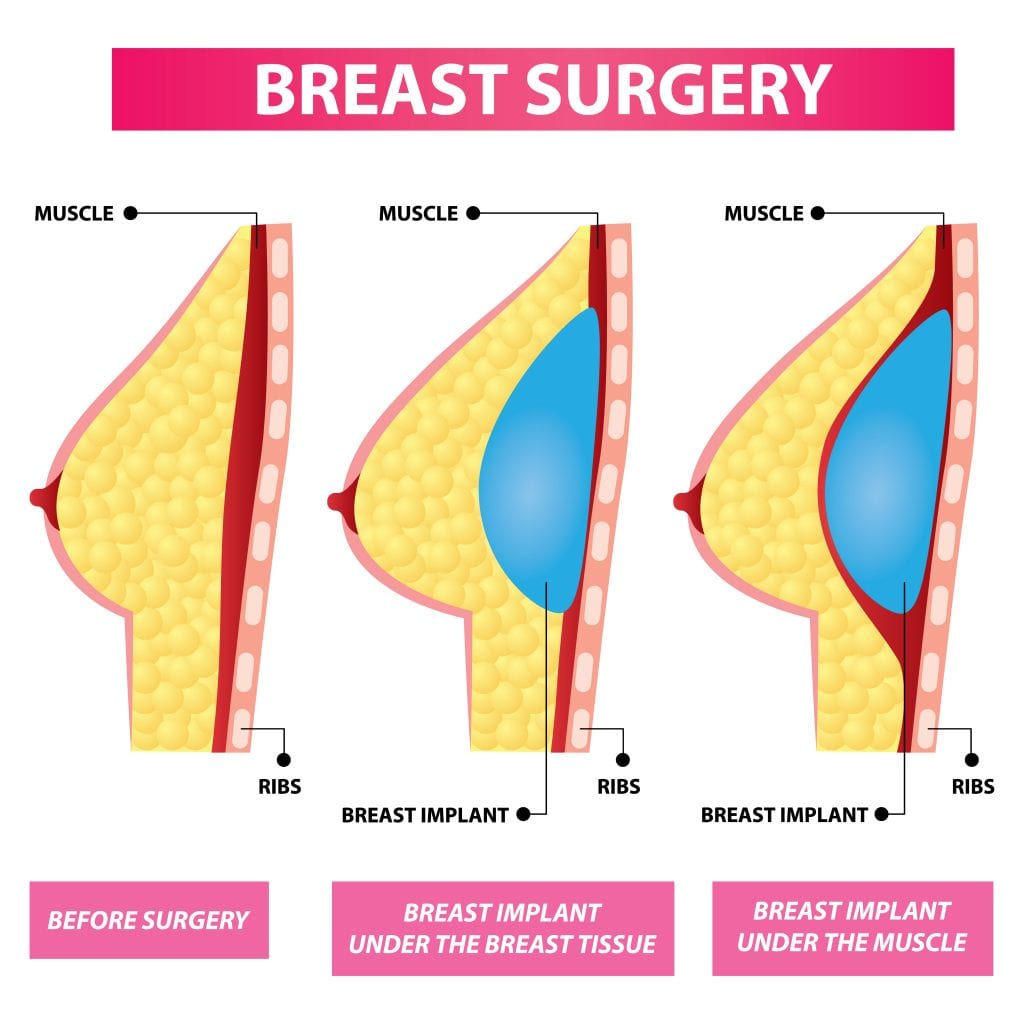 Diagram of Breast Implant Placement Options