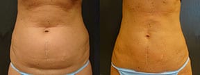 Body Procedures Actual Patient Results