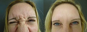 BOTOX® & Dysport® Actual Patient Results