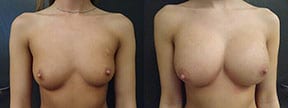 Breast Procedures Actual Patient Results