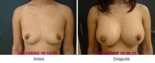 Breast Results 1
