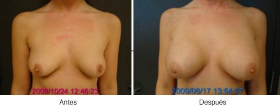 Breast Results 2