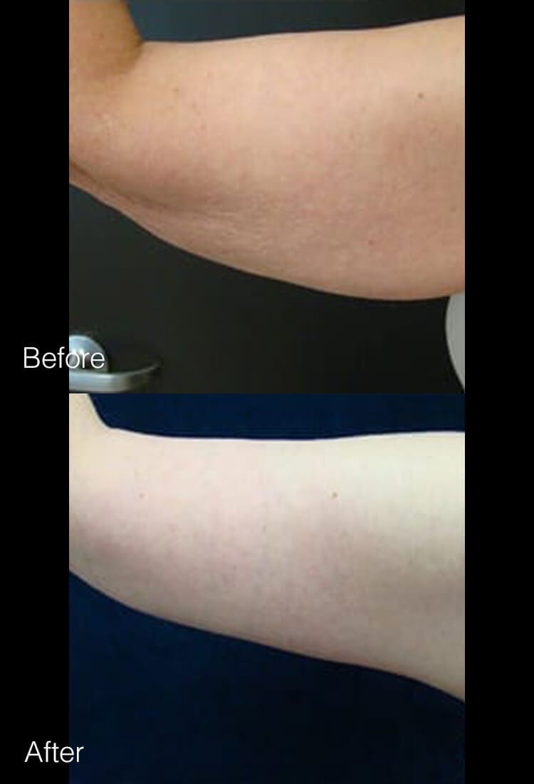 Arm lift surgery - Before & After