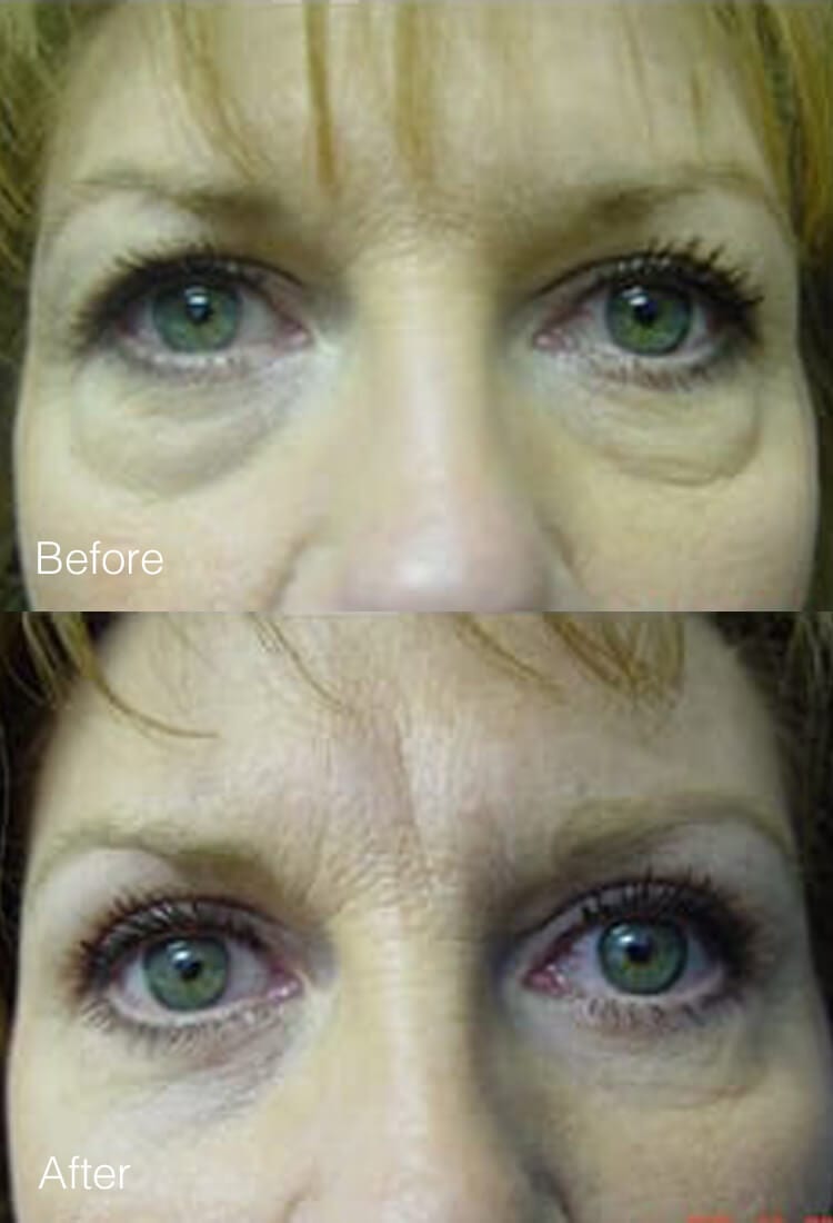 Eyelid Lift Surgery - Before & After