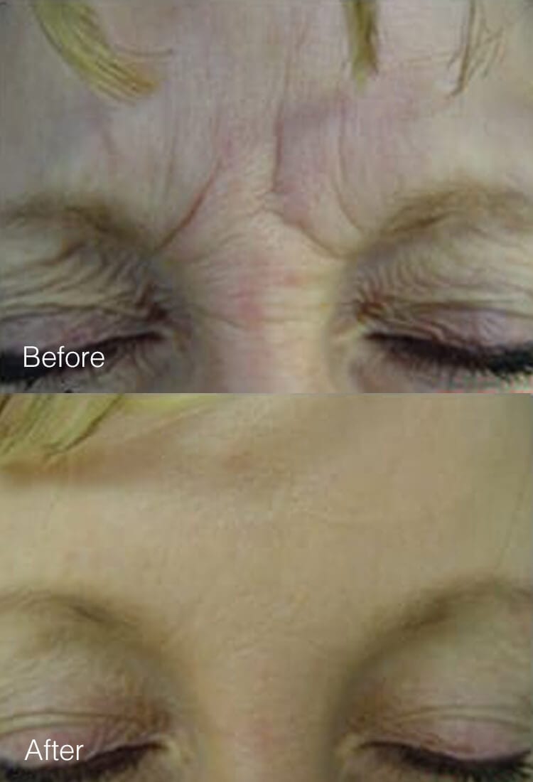 Botox & Dysport - Before & After