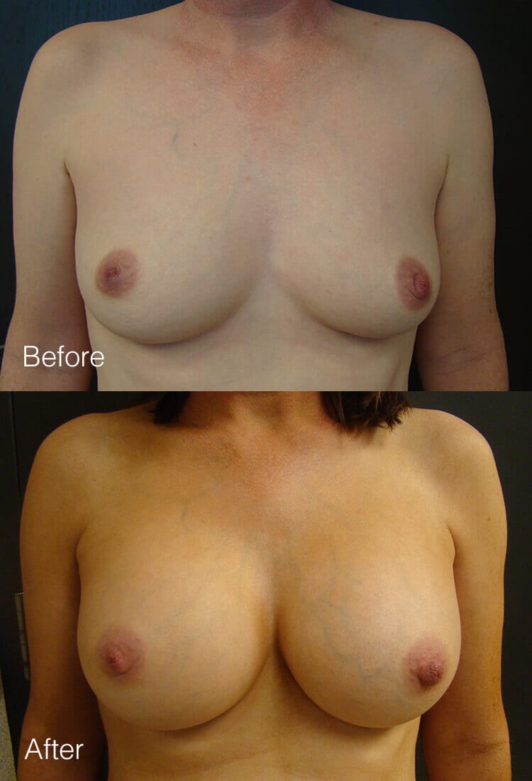 Breast augmentation - Before & After