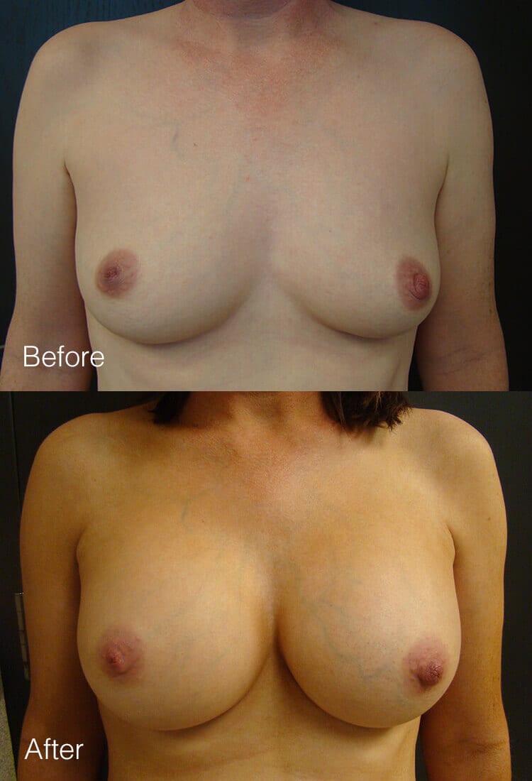 Breast Augmentation - Before & After