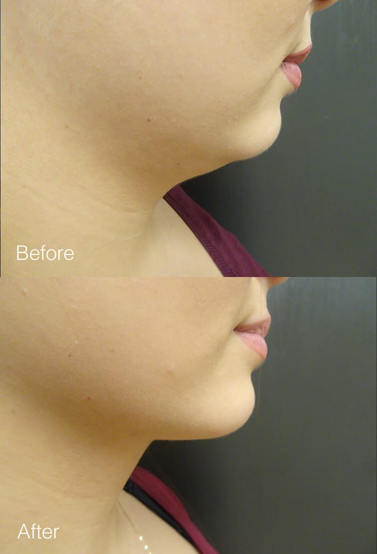 Chin Liposuction - Before & After