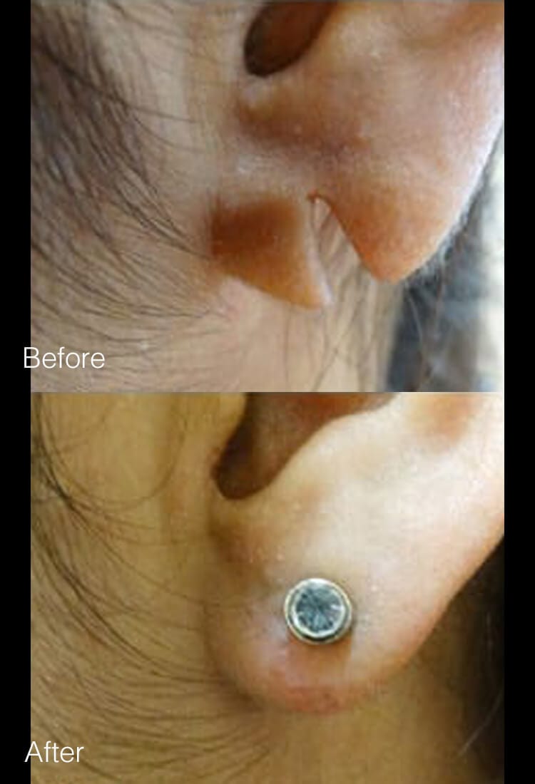 Earlobe Surgery - Before & After